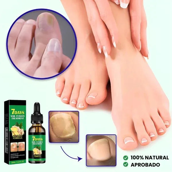 SPRAY ANTIMICÓTICO PARA UÑAS - TRATAMIENTO ANTIMICÓTICO 7 DÍAS 100% NATURAL